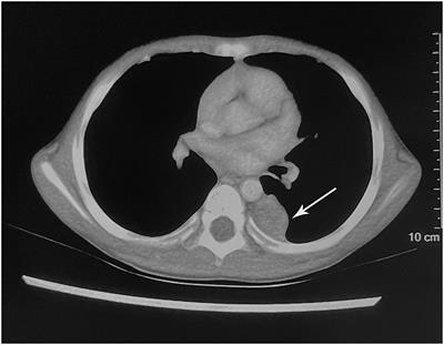 Case report: Primary pleural low-grade fibromyxoid sarcoma in a 4-year-old boy with molecular confirmation